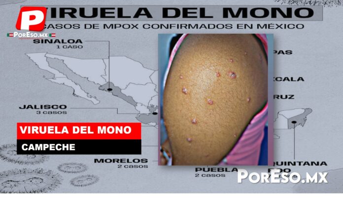 viruela del mono en campeche
